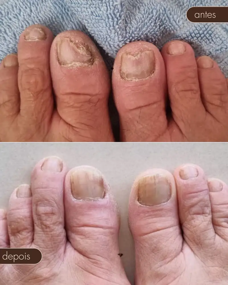 Antes e depois — Tratamento de micose